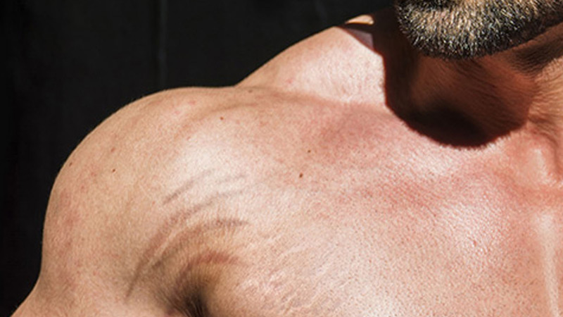 How To Get Rid Of Stretch Marks From Weight Lifting