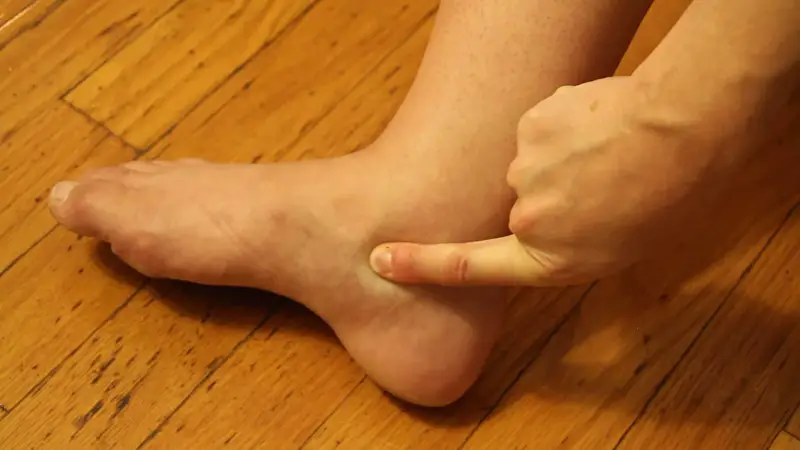 Losing Weight Reduce Ankle Swelling